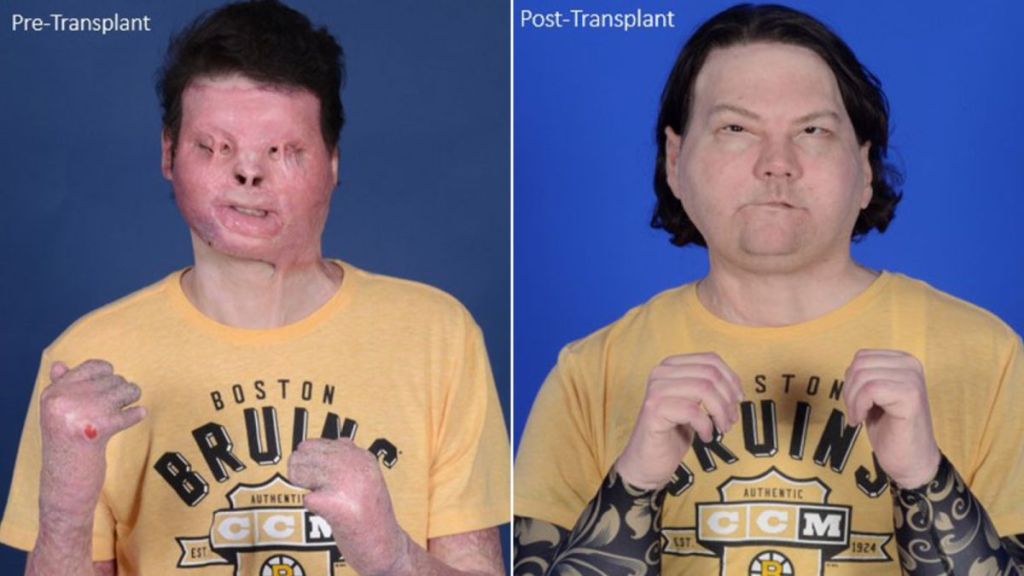 En EE.UU confirman primer trasplante exitoso de rostro y manos simultáneo