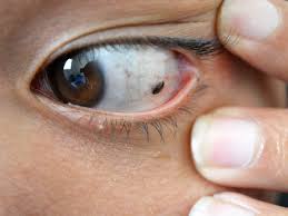 Manchas o lunares en los ojos podrían indicar presencia de cáncer