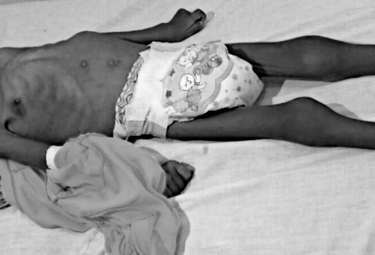 Dos casos de menores de edad muertos por desnutrición en Medellin