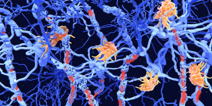 Identifican un posible origen de la esclerosis lateral amiotrófica