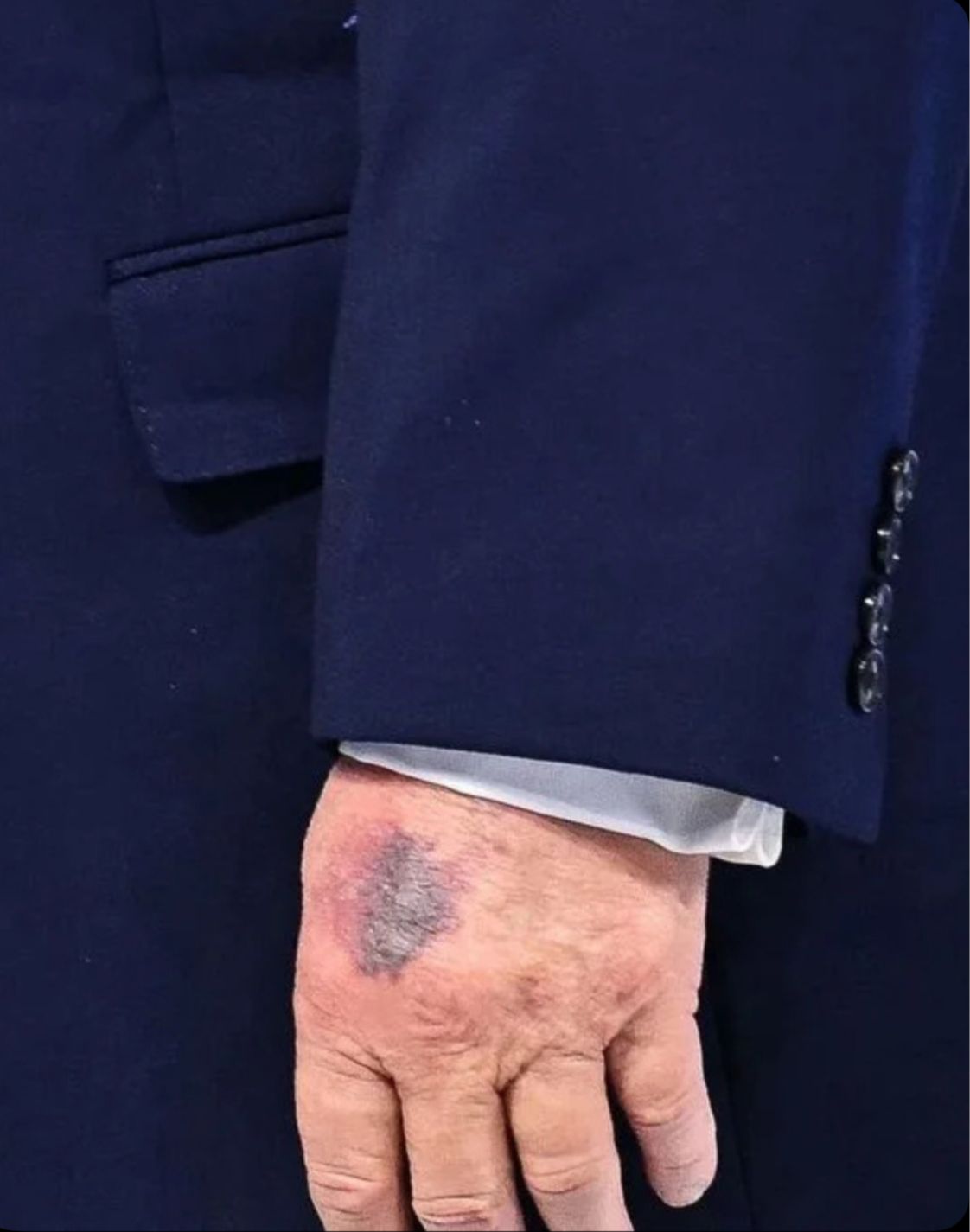Hematoma en la mano de Trump desata rumores sobre su salud tras aparición en Davos