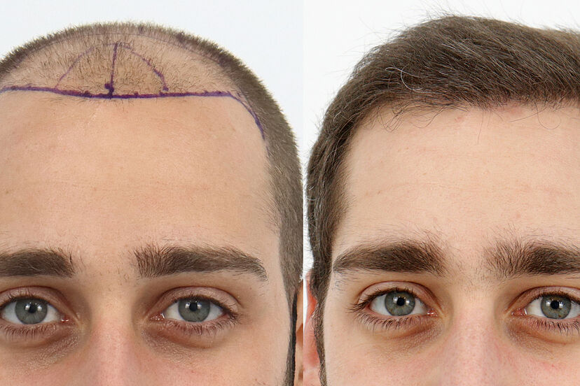 Implante capilar en la Costa Caribe: Guía completa para recuperar tu cabello