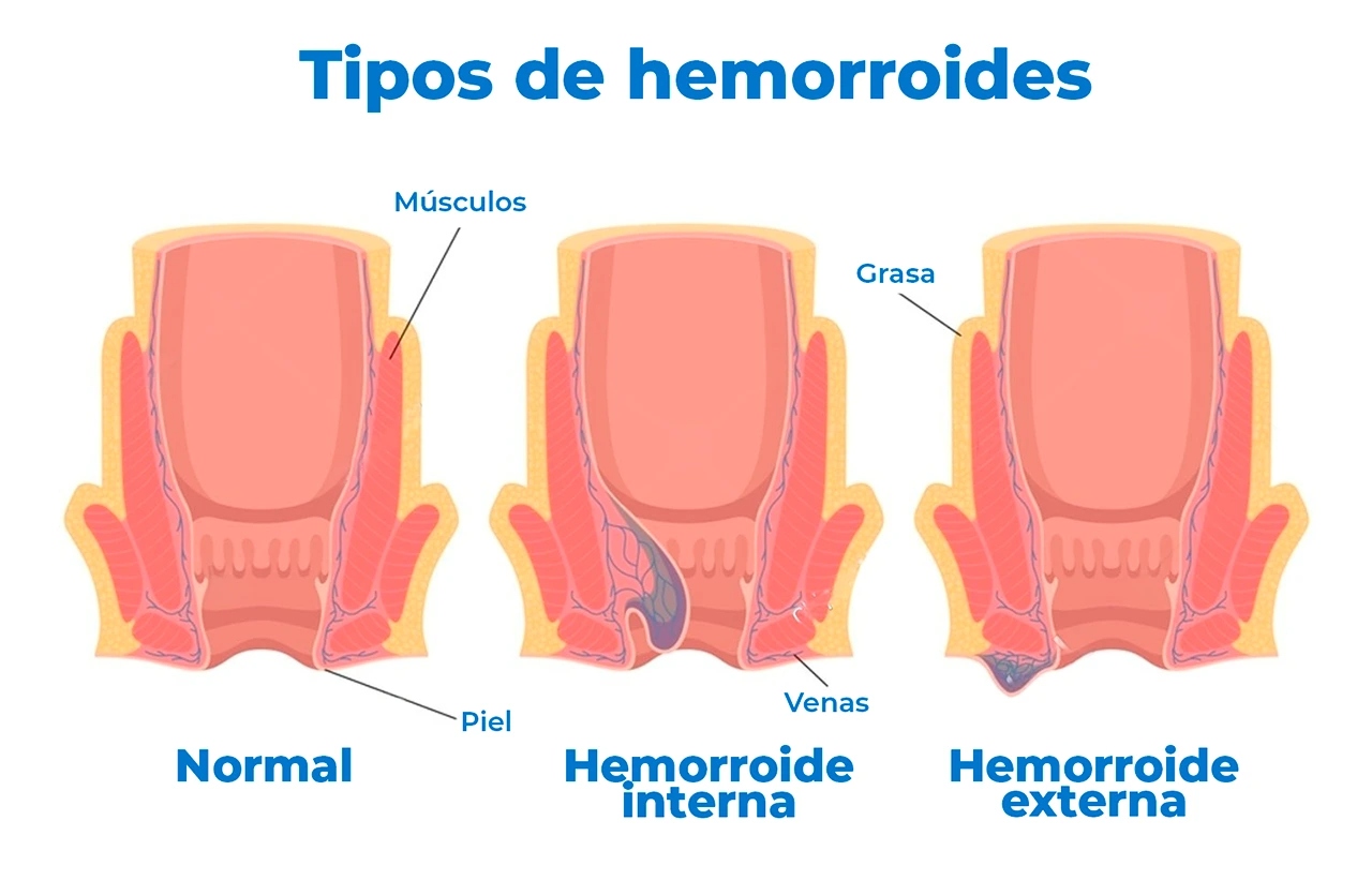 Especialistas presentan guía para mejorar el tratamiento de las hemorroides y hacen un llamado a consultar a tiempo